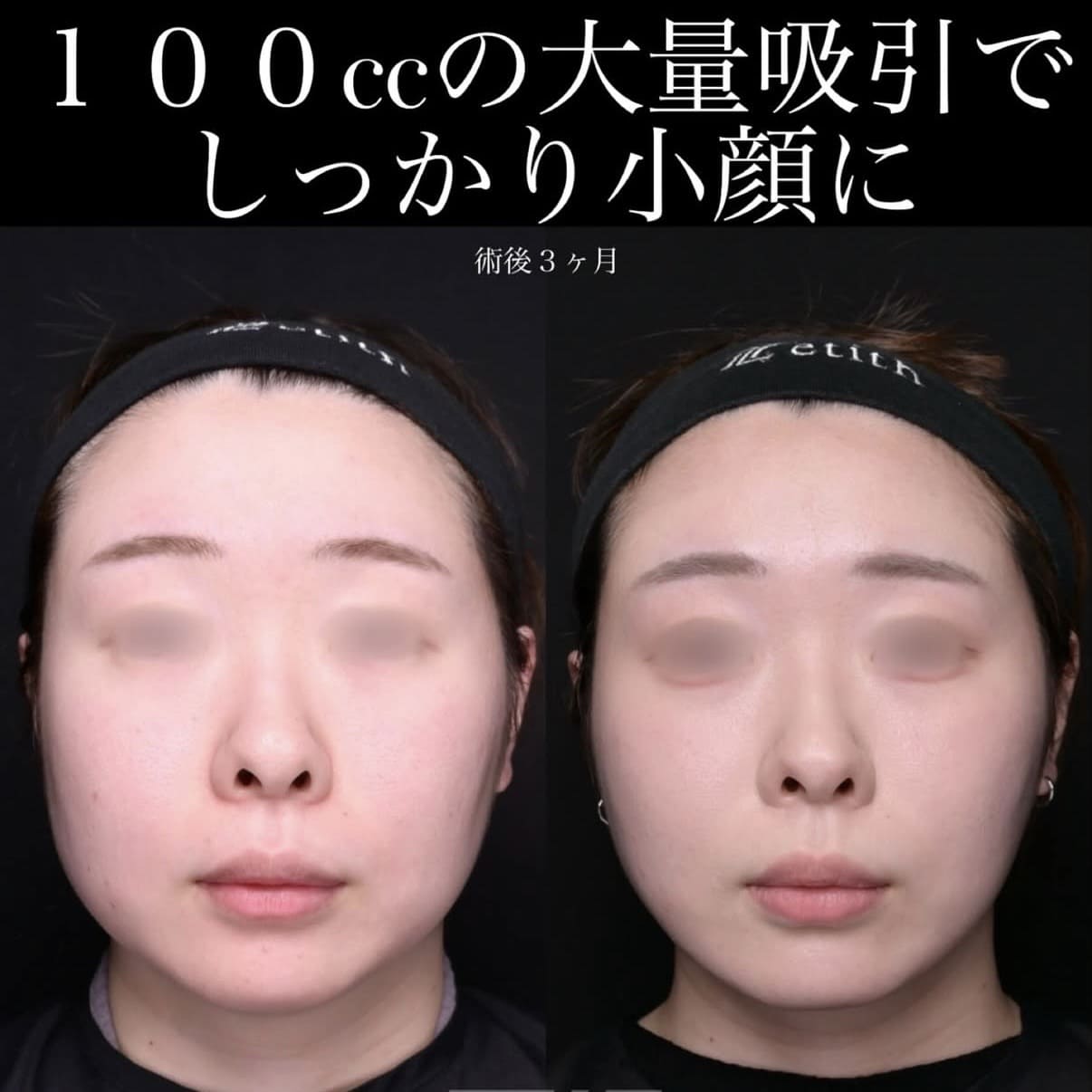 脂肪吸引リフト
