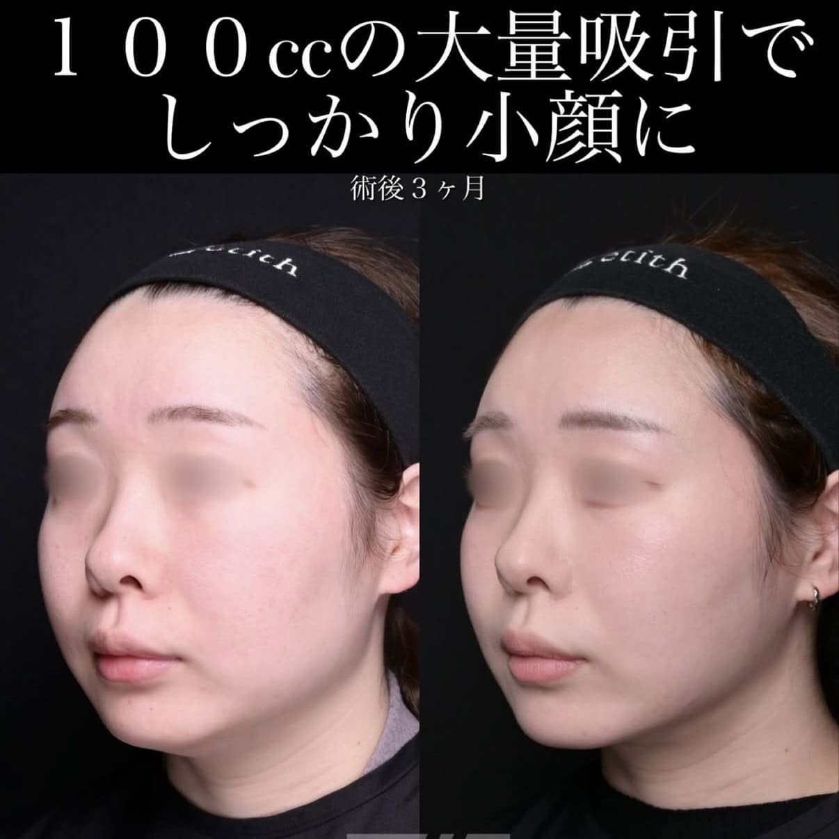 北村医師による脂肪吸引リフト術前/術後３ヵ月 بعد 