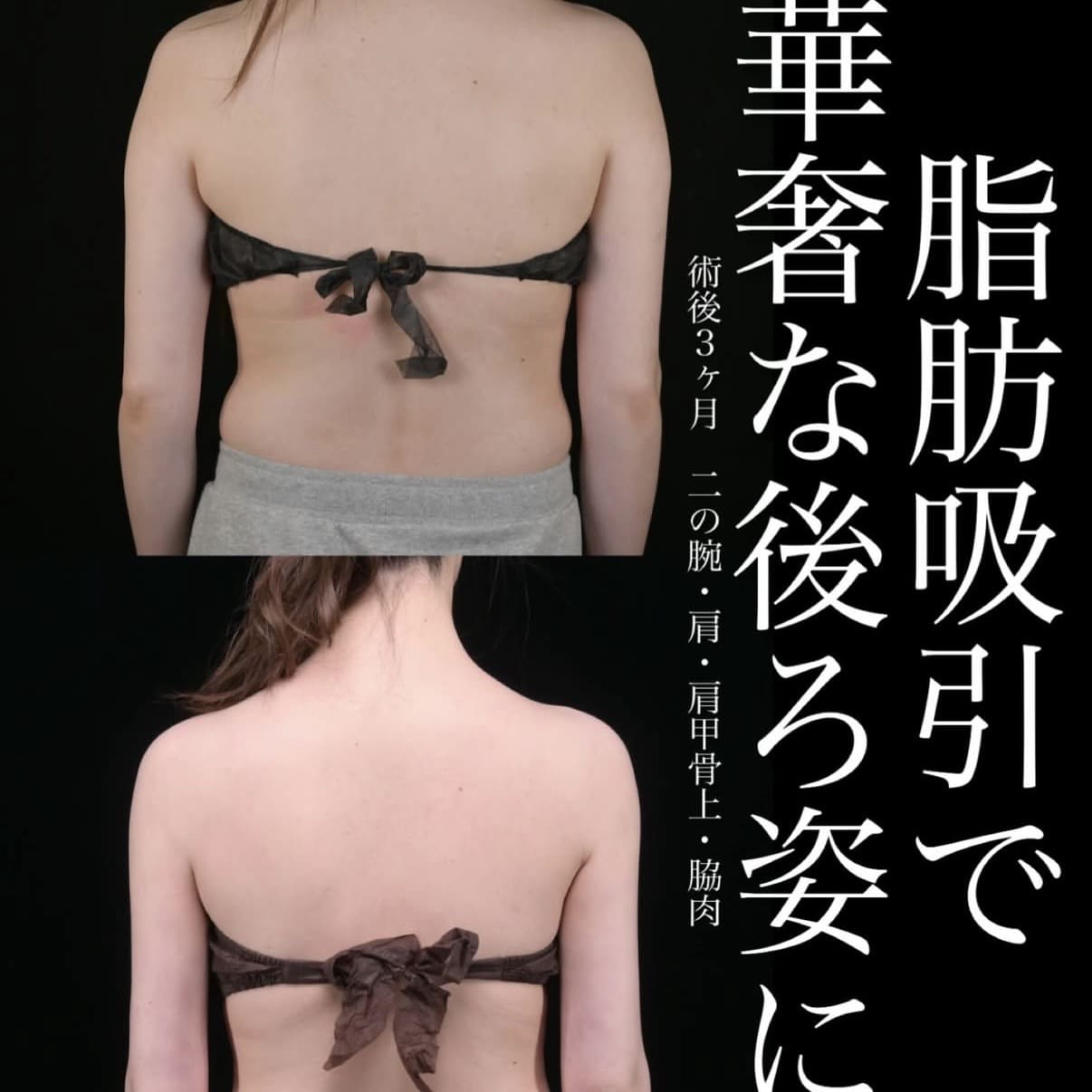 北村医師による脂肪吸引術前/術後3ヵ月