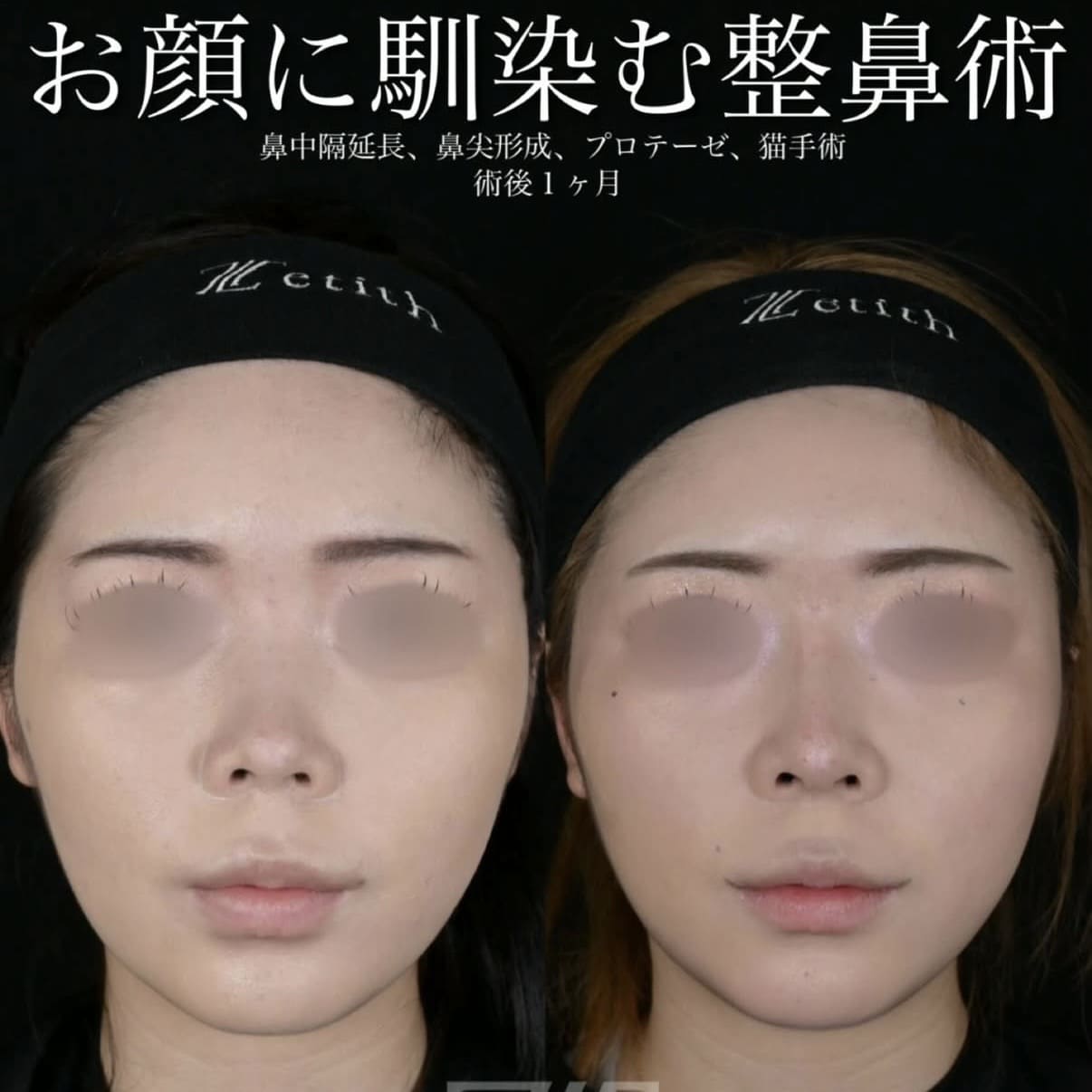 北村医師による鼻整形術前/術後1ヶ月 施術後 