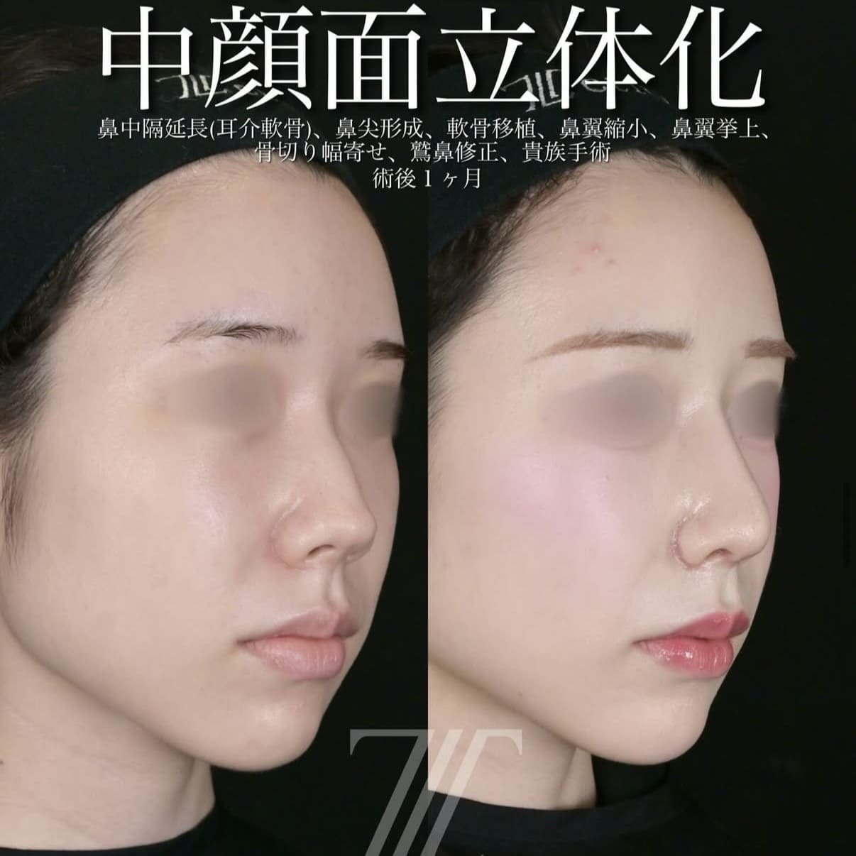 鼻整形
