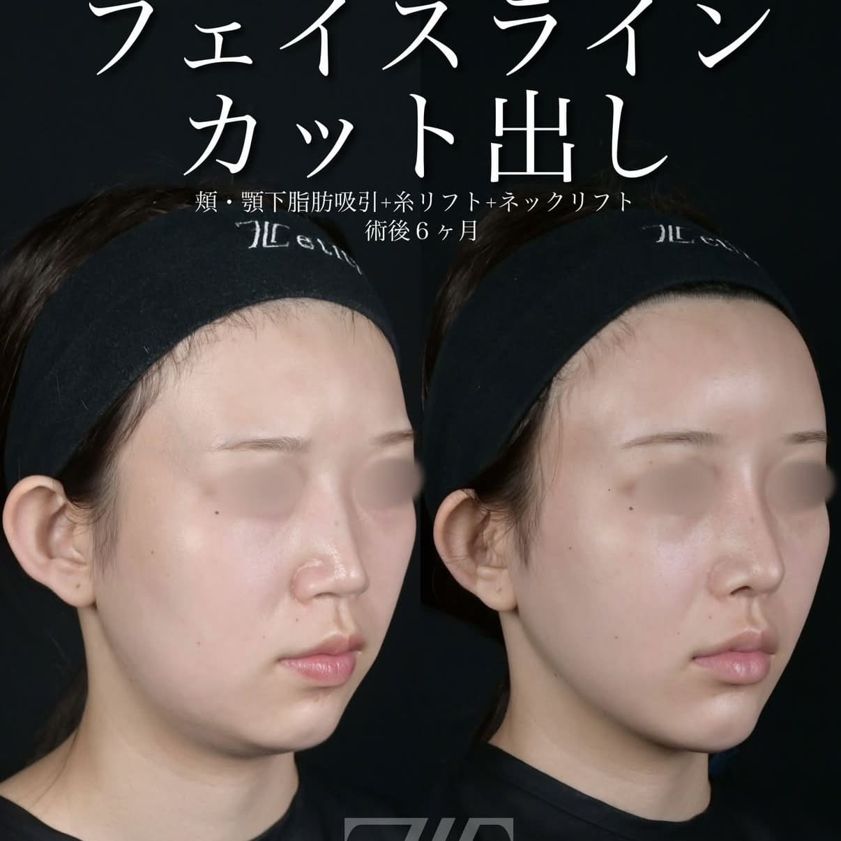 北村医師による脂肪吸引リフト術前/術後6ヵ月 术后 