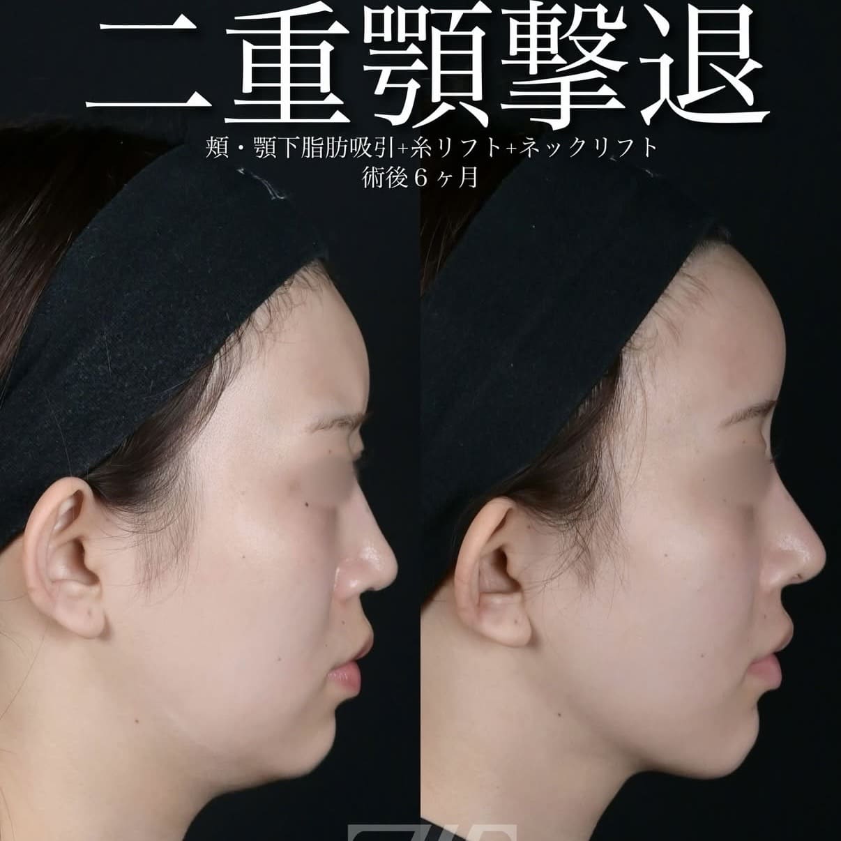 脂肪吸引リフト