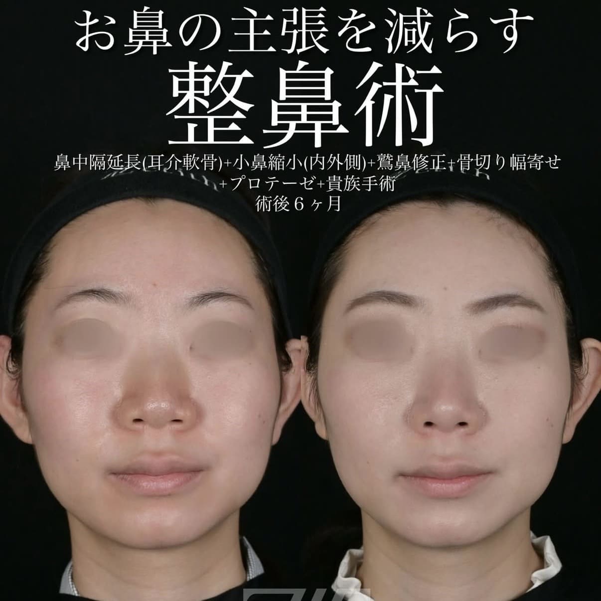 北村医師による鼻整形術前/術後６ヵ月 施術後 