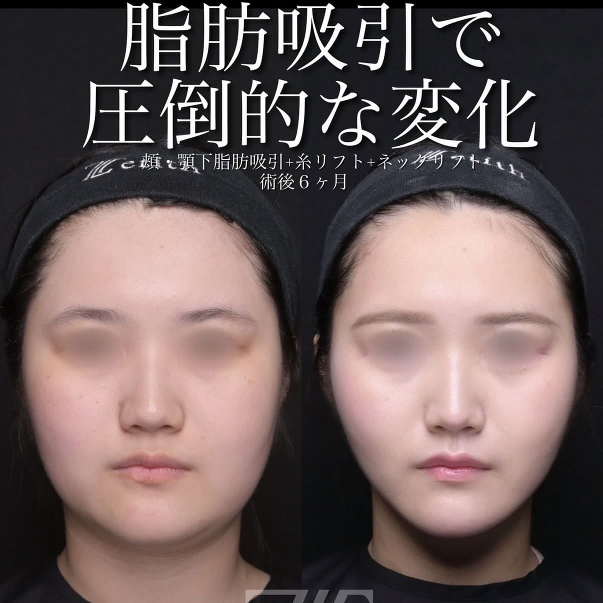 北村医師による脂肪吸引リフト術前/術後6ヵ月 بعد 