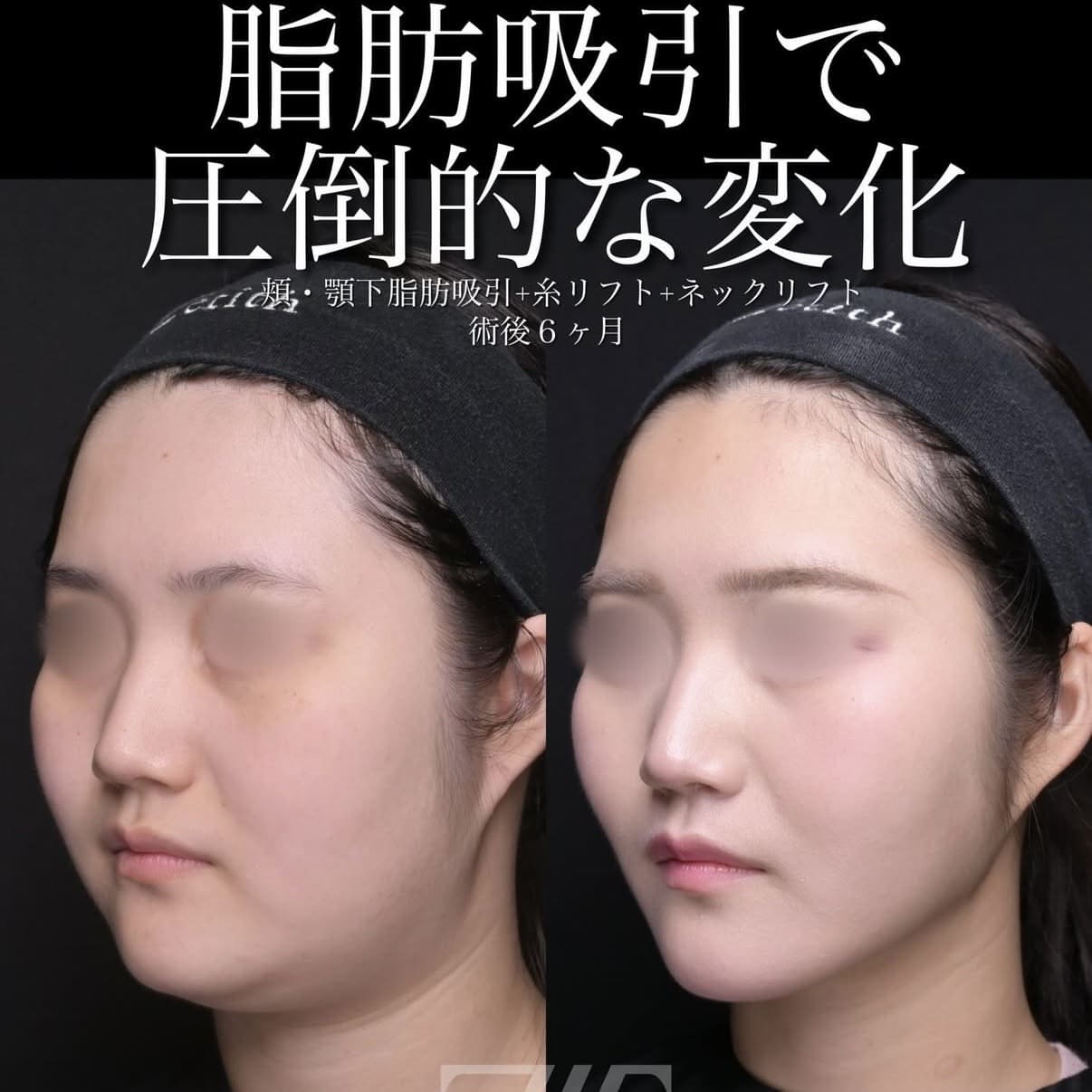 脂肪吸引リフト