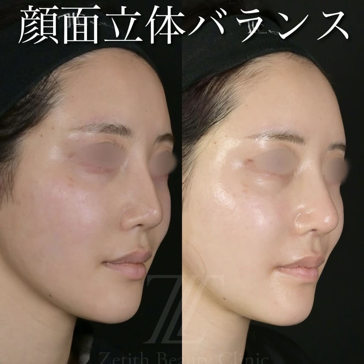 北村医師による複合施術術前/術後1ヵ月 施術後 