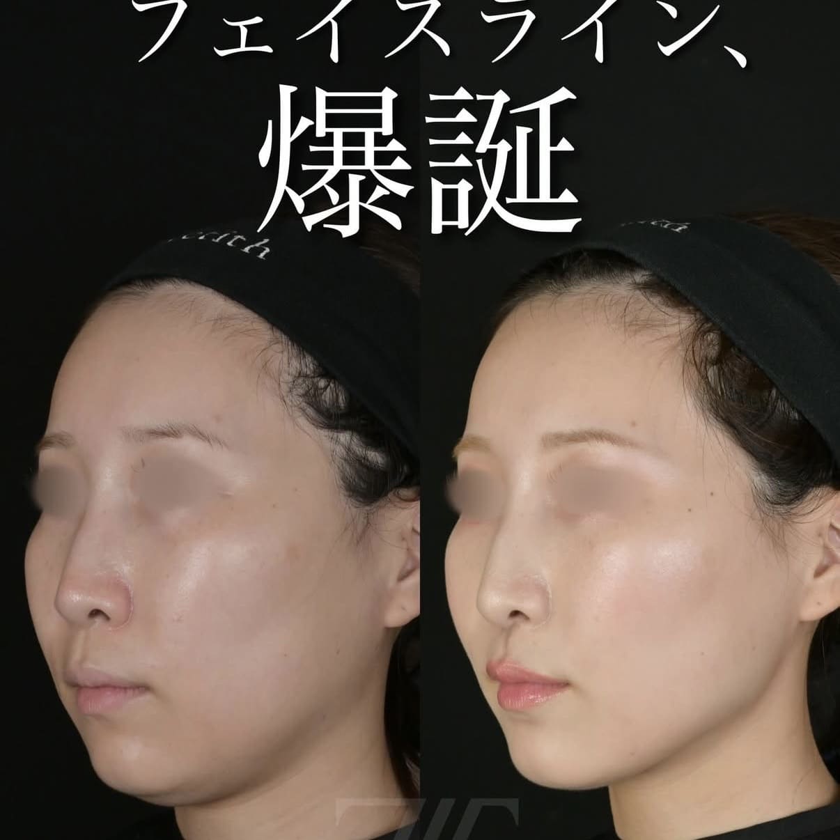 脂肪吸引リフト