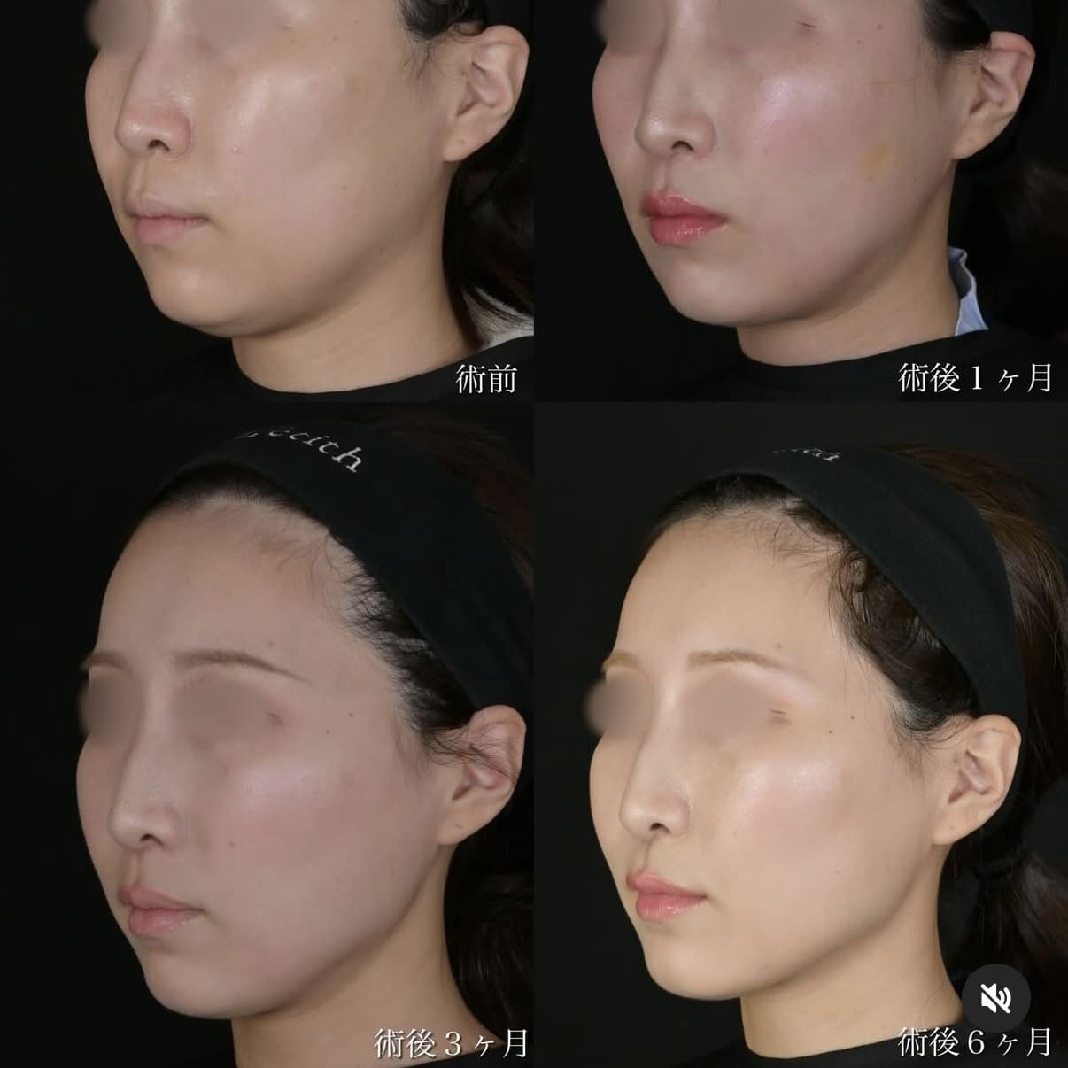 北村医師による脂肪吸引リフト術前/術後6ヵ月 بعد 