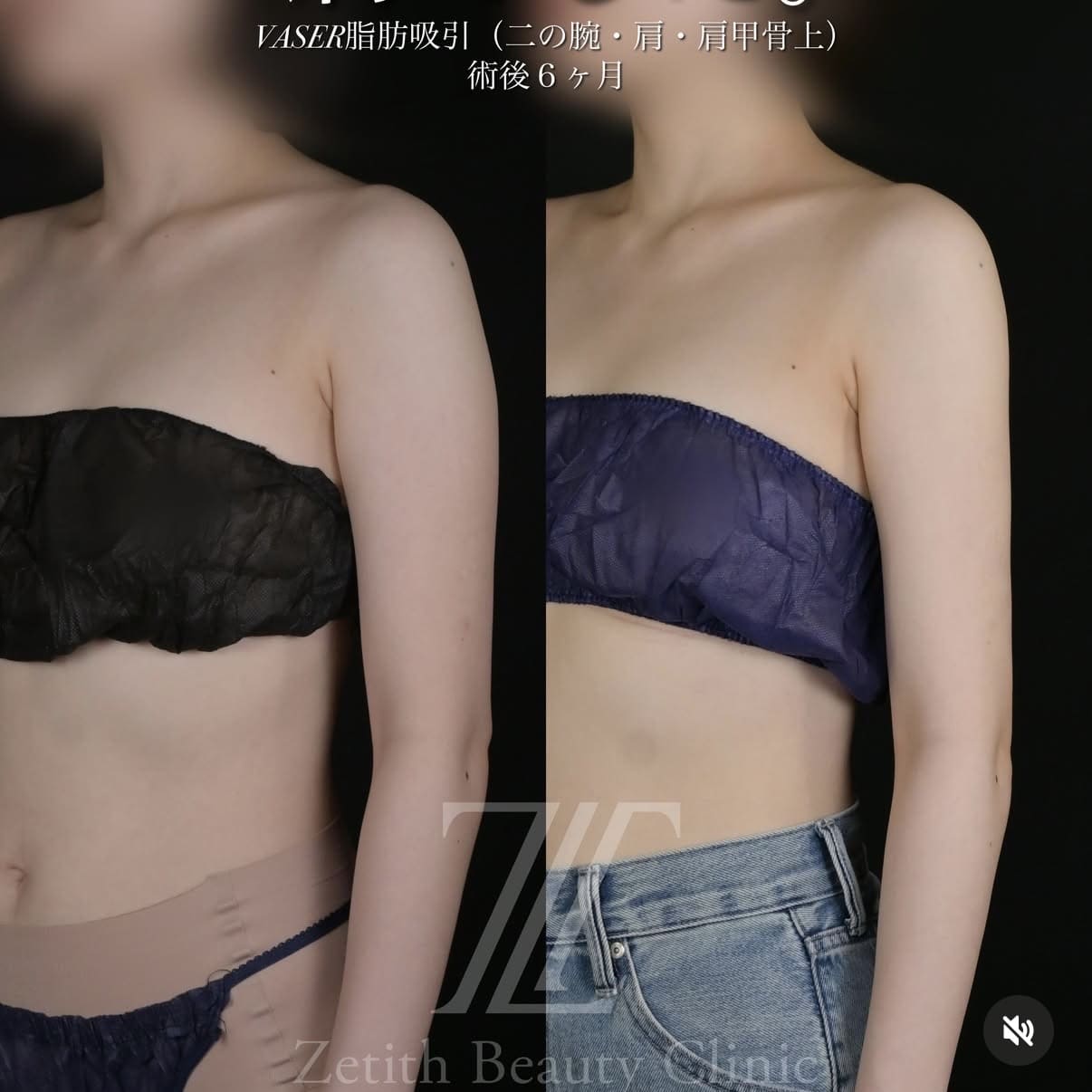 北村医師による脂肪吸引術前/術後6ヵ月