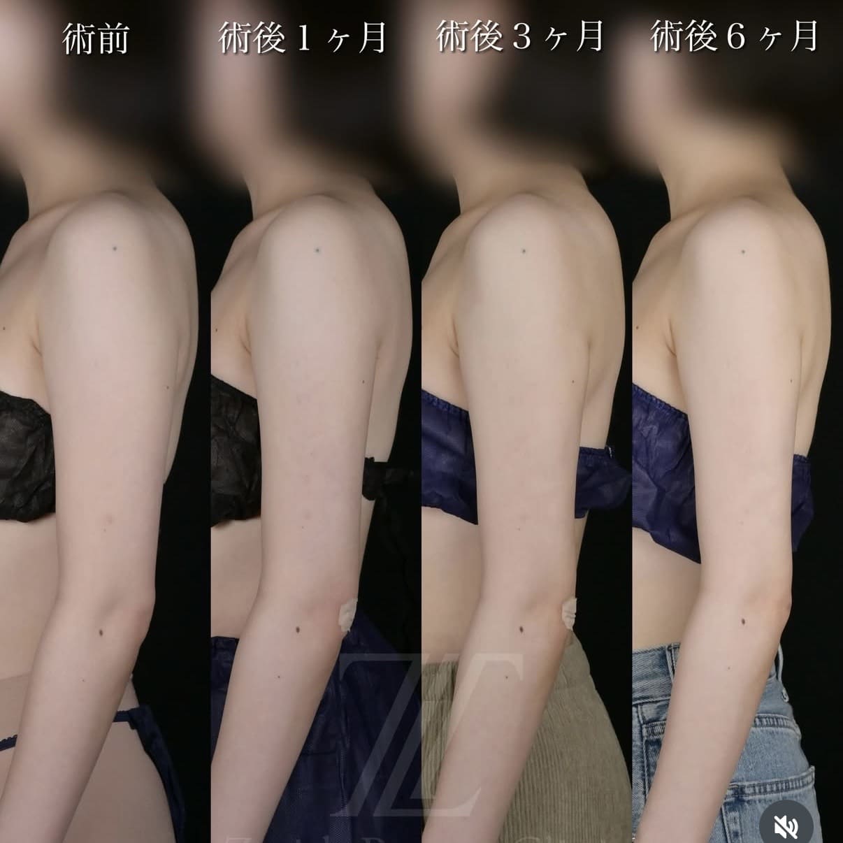 北村医師による脂肪吸引術前/術後6ヵ月 施術後 