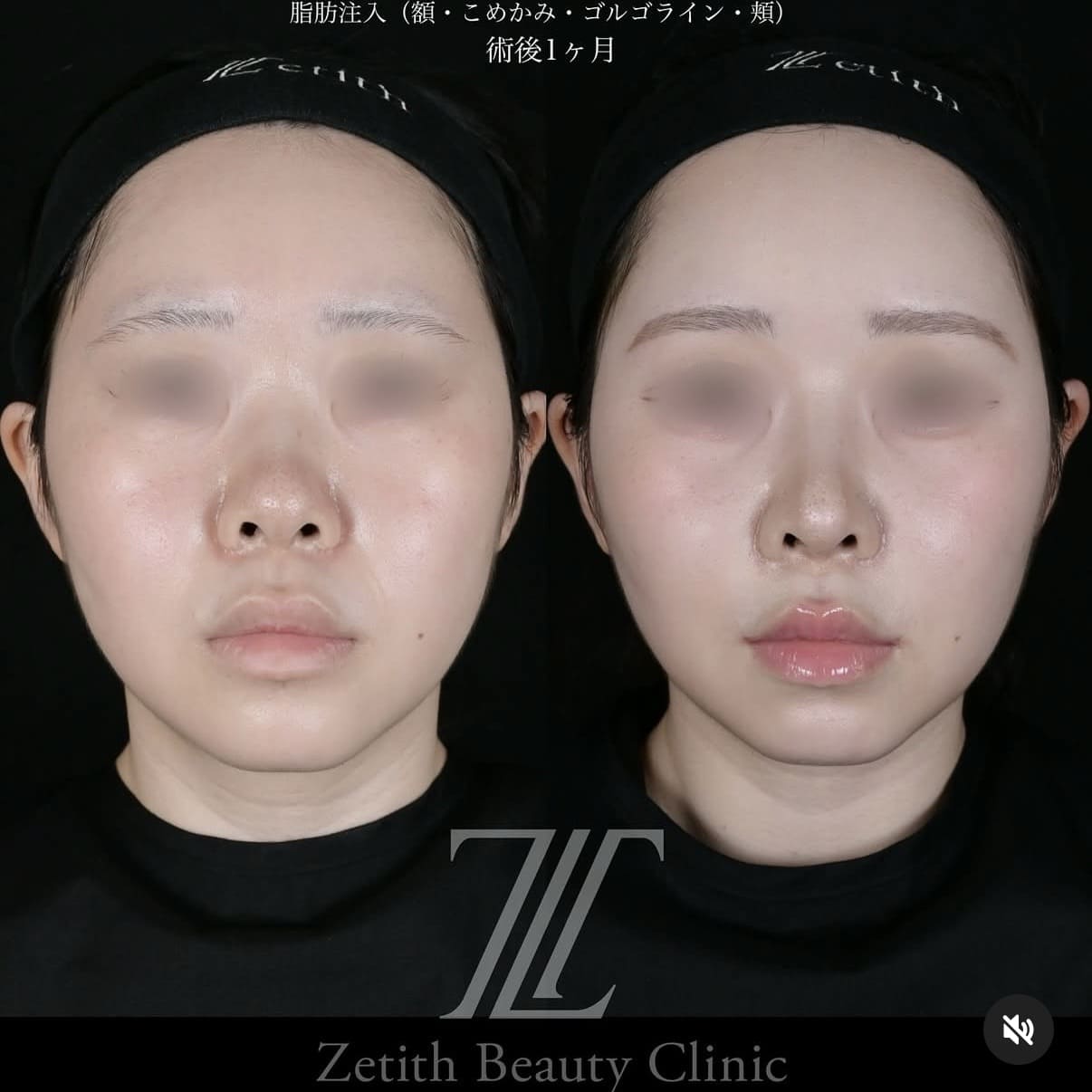 北村医師による鼻整形術前/術後1ヶ月 หลัง 
