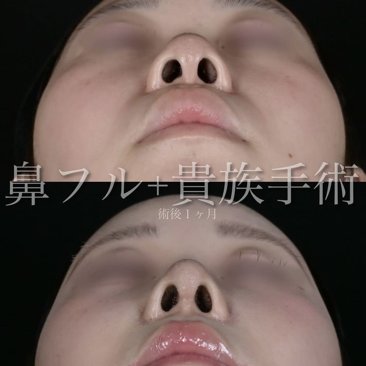 鼻整形